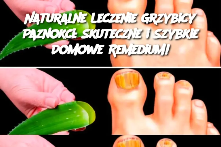 Naturalne Leczenie Grzybicy Paznokci: Skuteczne i Szybkie Domowe Remedium!