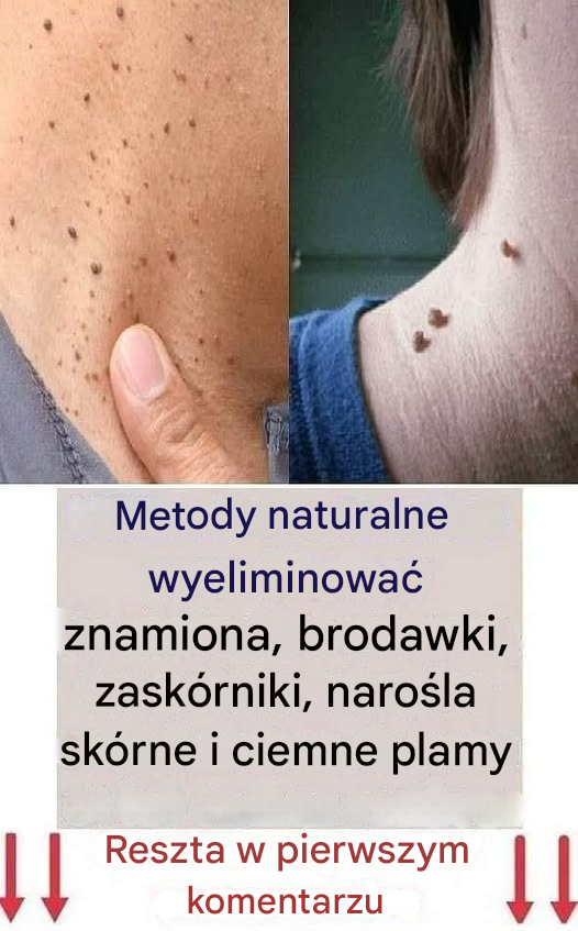 Usuń brodawki, zaskórniki i plamy starcze w sposób naturalny