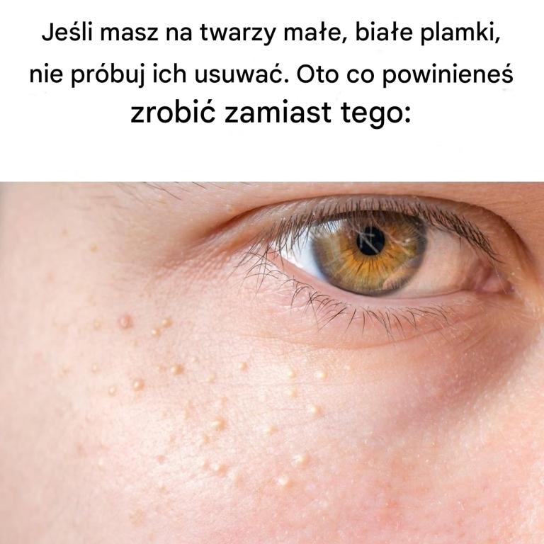 Jeśli masz na twarzy te małe, białe grudki, nie próbuj ich usuwać!