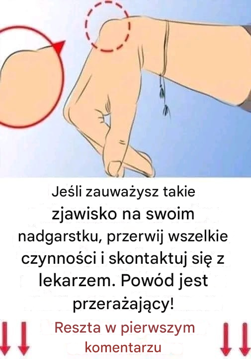 Jeśli zauważyłeś u siebie taki guzek na nadgarstku, może to być powód do zmartwień.