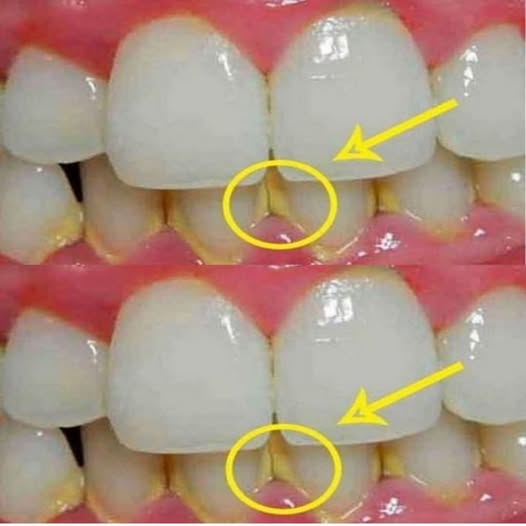 Usuń płytkę nazębną w 5 minut w sposób naturalny, bez wizyty u dentysty