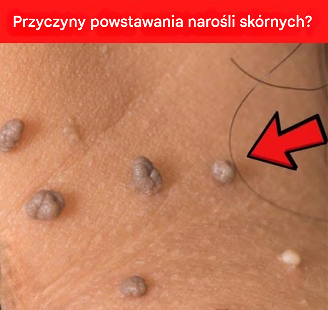 Co właściwie oznaczają narośla skórne (przyczyny powstawania narośli skórnych)