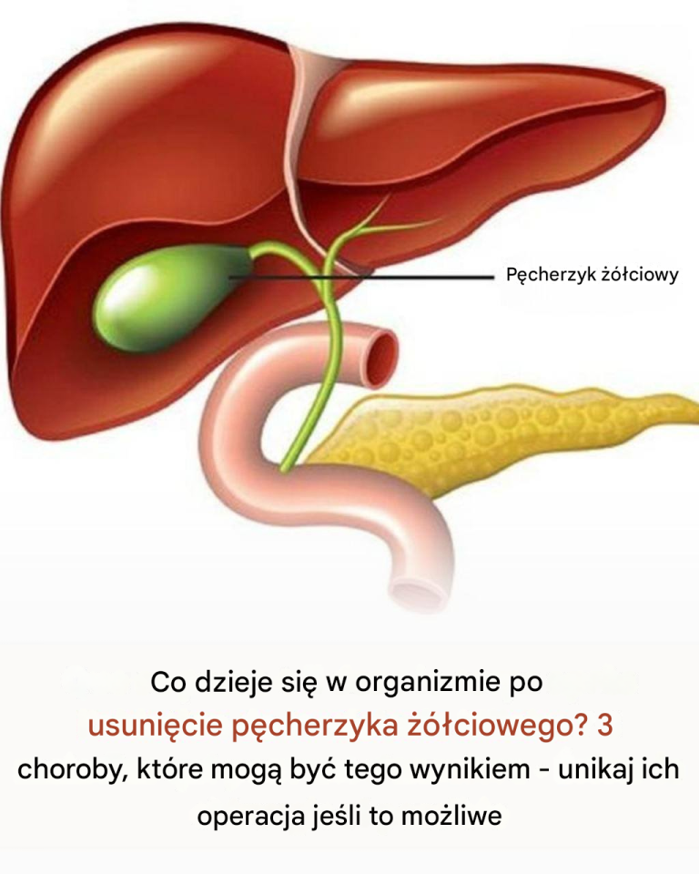 Co dzieje się w organizmie po usunięciu pęcherzyka żółciowego?