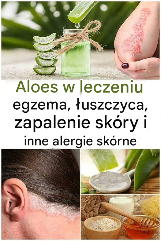 Aloes w leczeniu egzemy, łuszczycy, zapalenia skóry i innych alergii skórnych