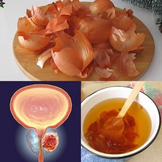 Pęcherz i prostata jak nowe! Skórka starej cebuli: lekarstwo dziadka