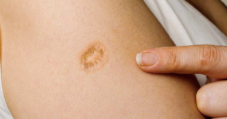 Dlaczego wiele osób ma małą bliznę na lewym ramieniu?