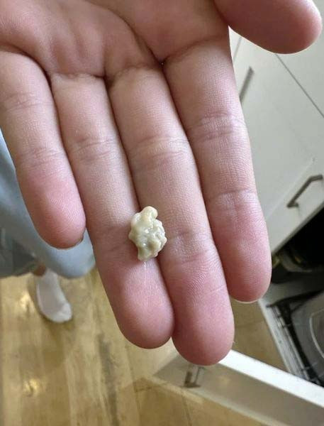 Wszystko, co musisz wiedzieć o kamieniach migdałkowych