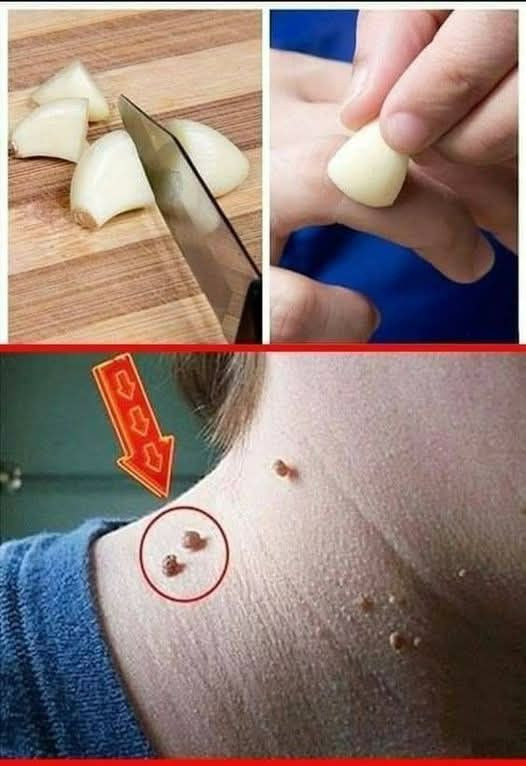 Naturalnie pozbądź się brodawek, zaskórników i plam starczych