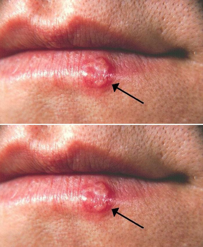 Herpes: naturalne i skuteczne metody leczenia, które warto znać