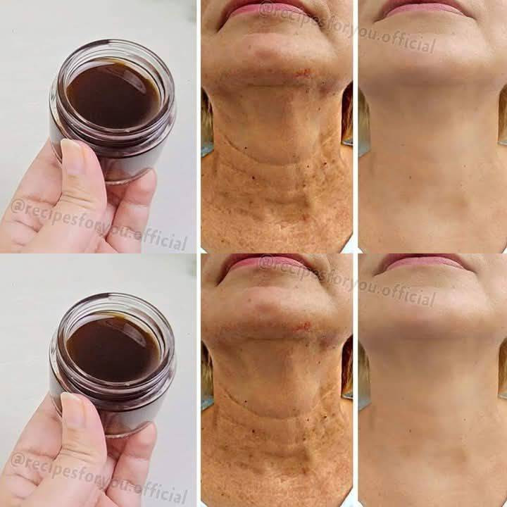 Porada przeciwstarzeniowa: ten przepis naturalnie usunie wszystkie zmarszczki na Twojej twarzy…