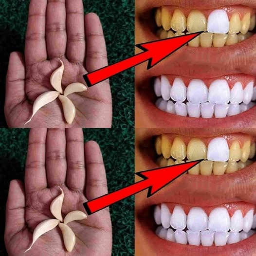 Jak wybielić zęby czosnkiem?