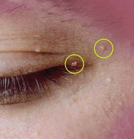 Jak pozbyć się torbieli Milia