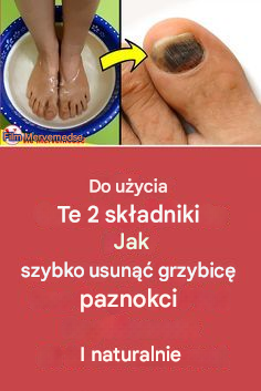 Łatwy sposób na grzybicę paznokci