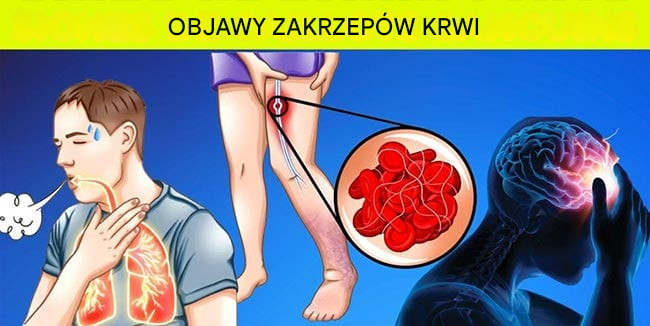 9 ostrzegawczych objawów zakrzepów krwi, których absolutnie nie wolno ignorować