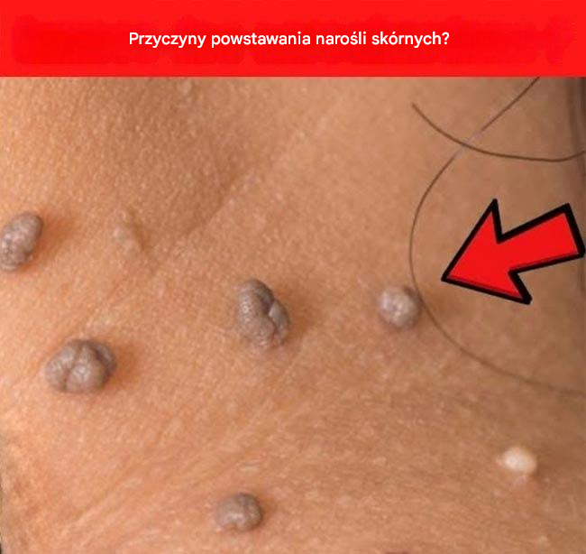 Co właściwie oznaczają narośla skórne (przyczyny powstawania narośli skórnych)