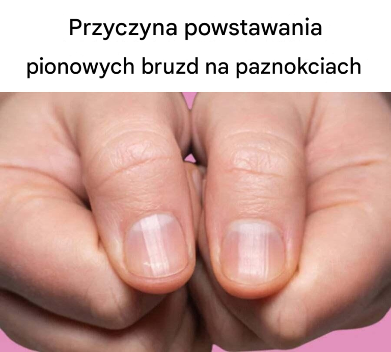 Przyczyna powstawania pionowych bruzd na paznokciach