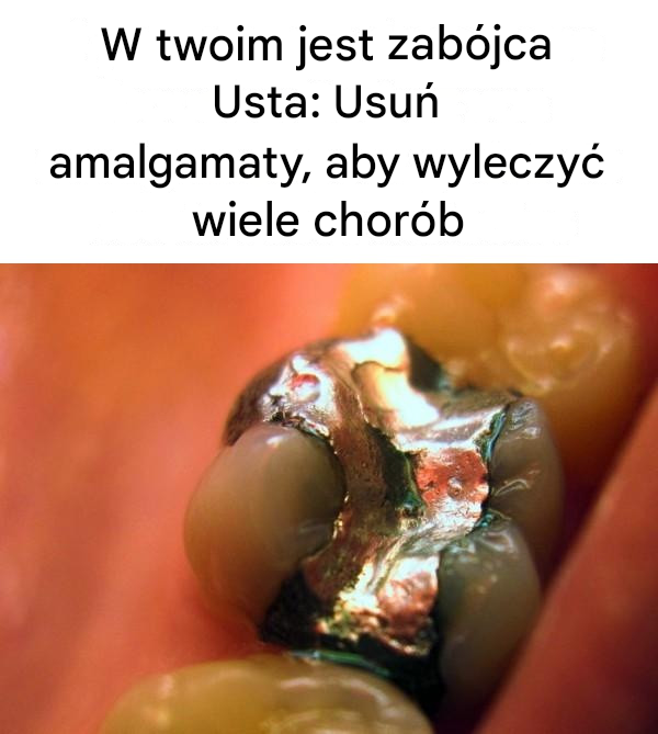 W Twoich ustach jest zabójca: usuń wypełnienia amalgamatowe, aby wyleczyć wiele chorób