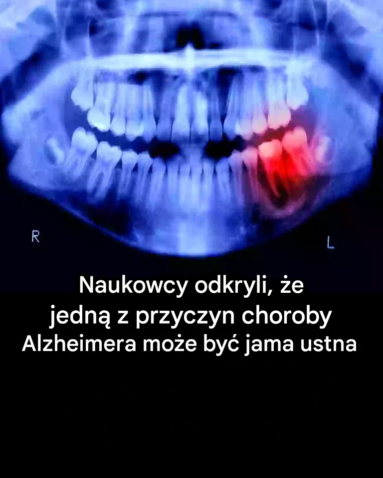 Naukowcy odkryli, że jedną z przyczyn choroby Alzheimera może być wnętrze jamy ustnej