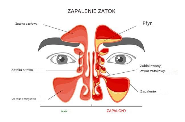 Jak leczyć zapalenie zatok w sposób naturalny?
