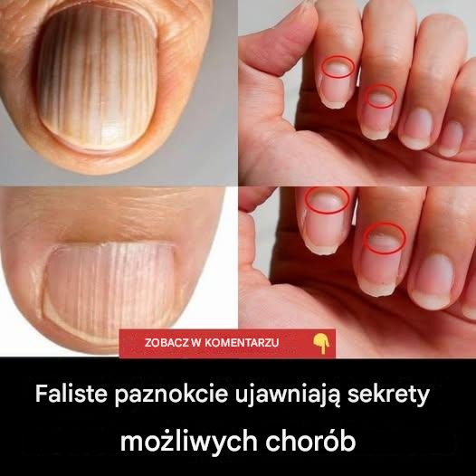 Faliste paznokcie ujawniają sekrety możliwych chorób