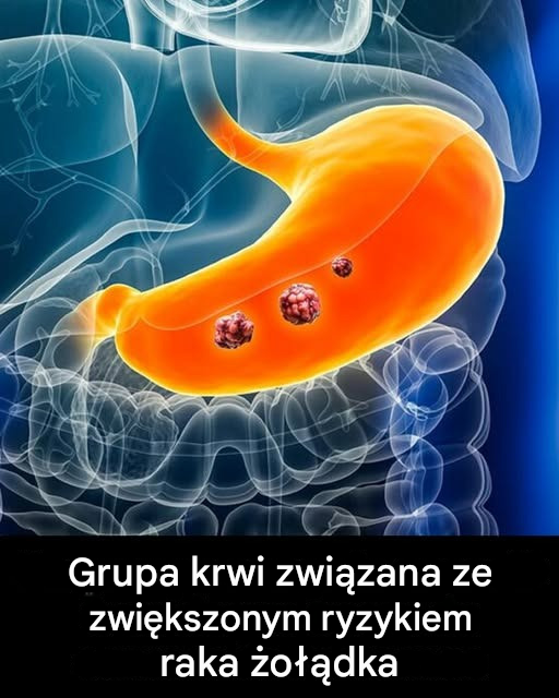 Eksperci ujawniają grupę krwi, która wiąże się z największym ryzykiem zachorowania na raka żołądka