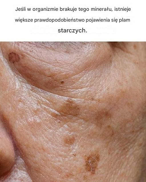 Jak zredukować plamy starcze: przyczyny, leczenie i zapobieganie