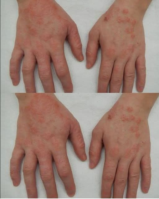 Oto 6 produktów spożywczych, których należy unikać w przypadku egzemy