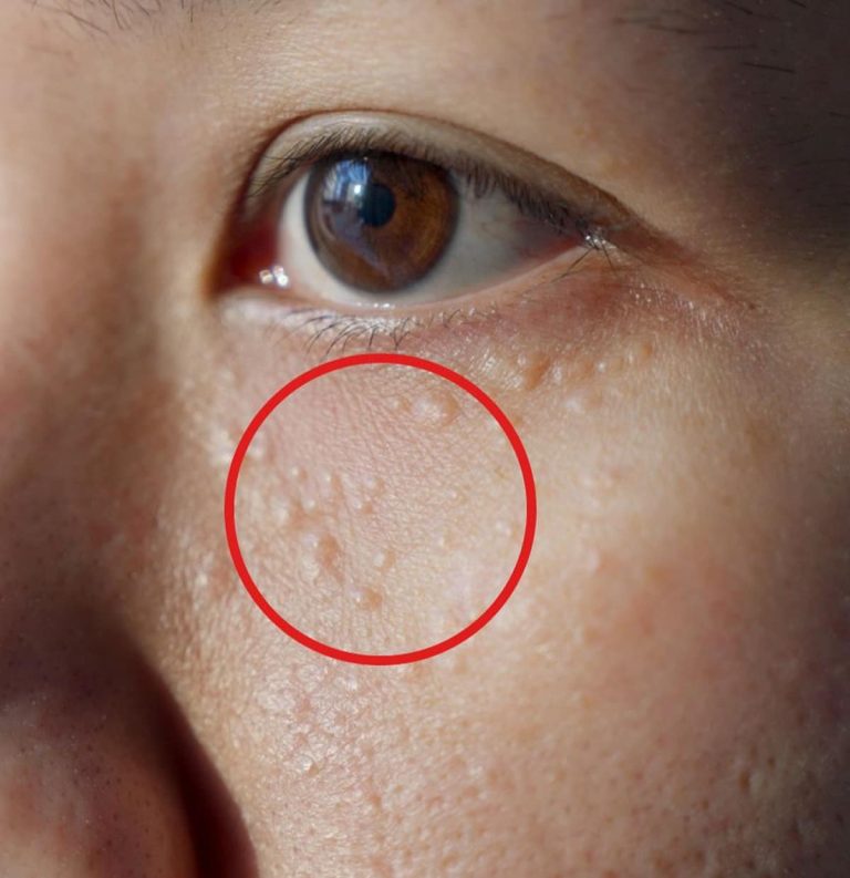 Jak pozbyć się prosaków, czyli uciążliwych torbieli tłuszczowych