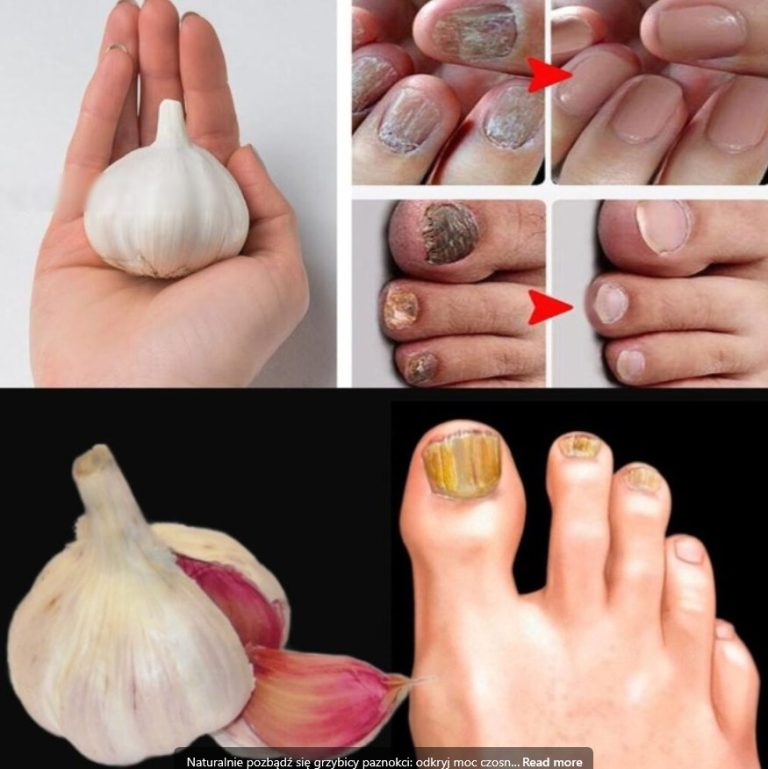 Pojedynczy tytuł: „Naturalny sposób leczenia grzybicy paznokci – odkryj skuteczność czosnku”
