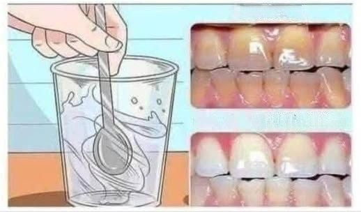 Jak usunąć kamień nazębny i wybielić zęby w sposób naturalny