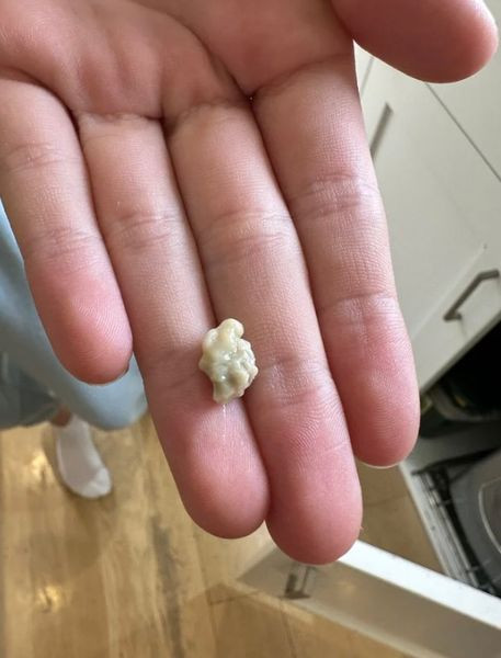 Wszystko, co musisz wiedzieć o kamieniach migdałkowych, dziwnych naroślach wyglądających jak pryszcze w gardle.