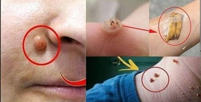 Naturalny środek na usuwanie brodawek