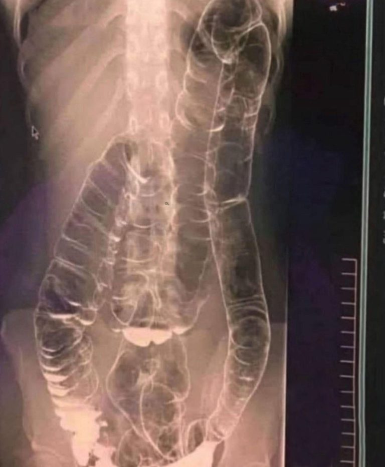 Przewlekłe zaparcia: cicha choroba