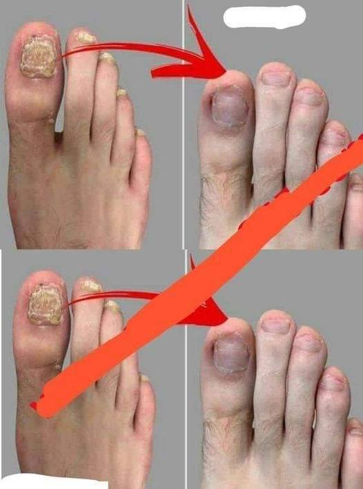 5 naturalnych środków na leczenie grzybicy paznokci