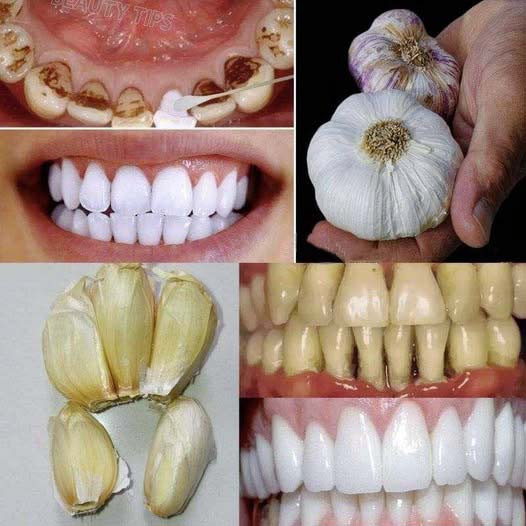 Jak wybielić zęby i usunąć kamień nazębny za pomocą czosnku?