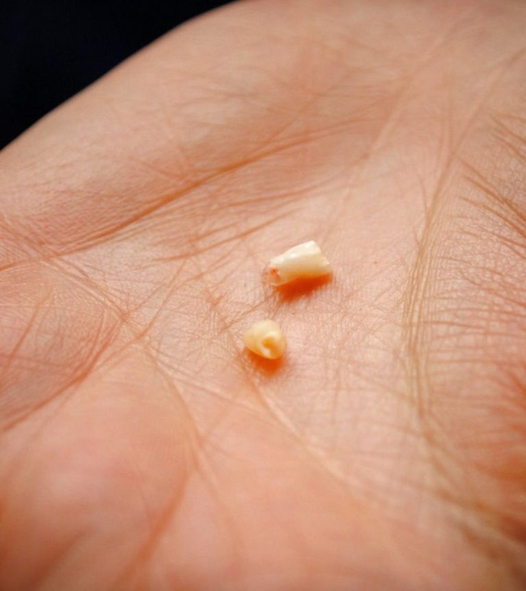 Dlaczego warto zachować mleczne zęby dziecka?