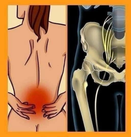 Naturalne środki na ból pleców i rwę kulszową