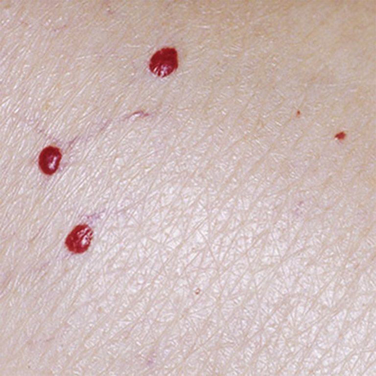 Czerwone plamy na skórze: co oznaczają?