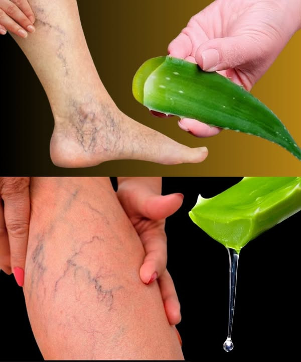 Jak pozbyć się żylaków i złagodzić uczucie ciężkich nóg za pomocą aloesu