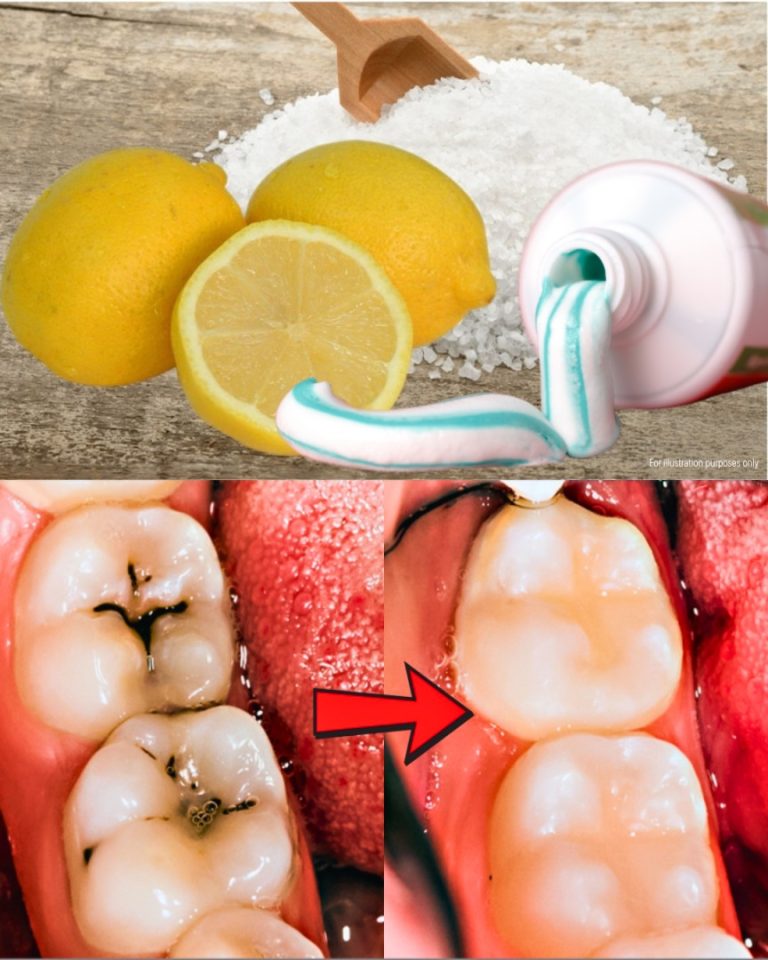 Jak leczyć próchnicę naturalnie?