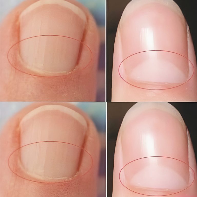 Co oznacza półksiężyc u nasady paznokci?