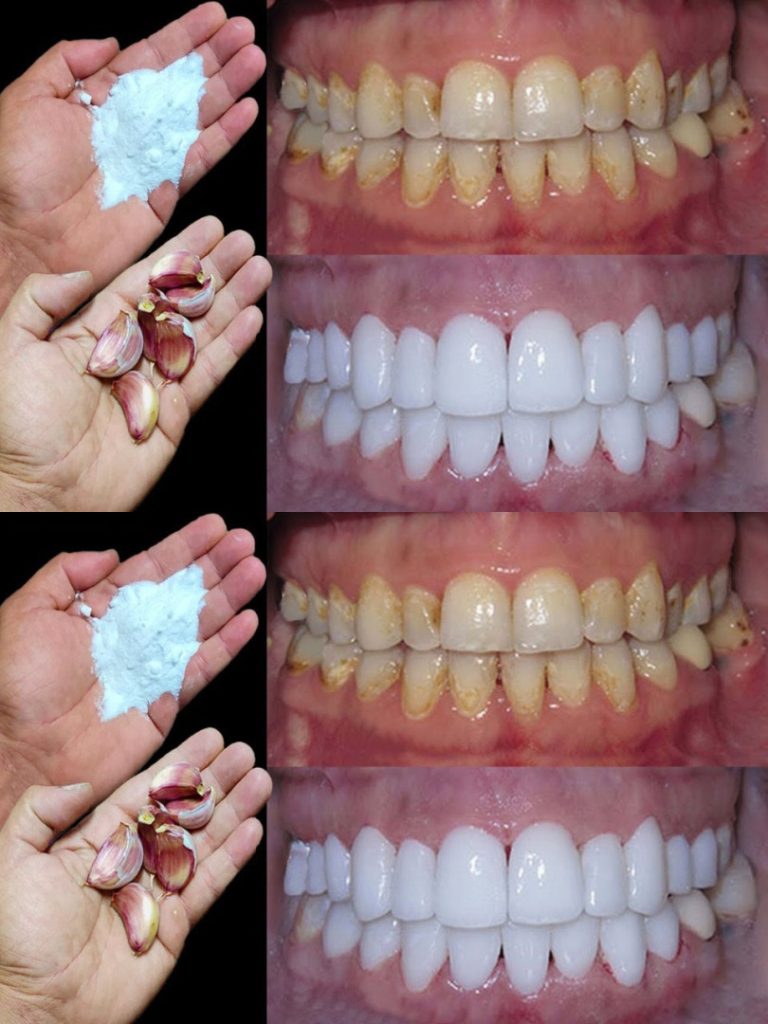 Jak wybielić zęby w 2 minuty?