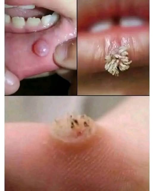 Babcine sposoby na naturalne leczenie opryszczki