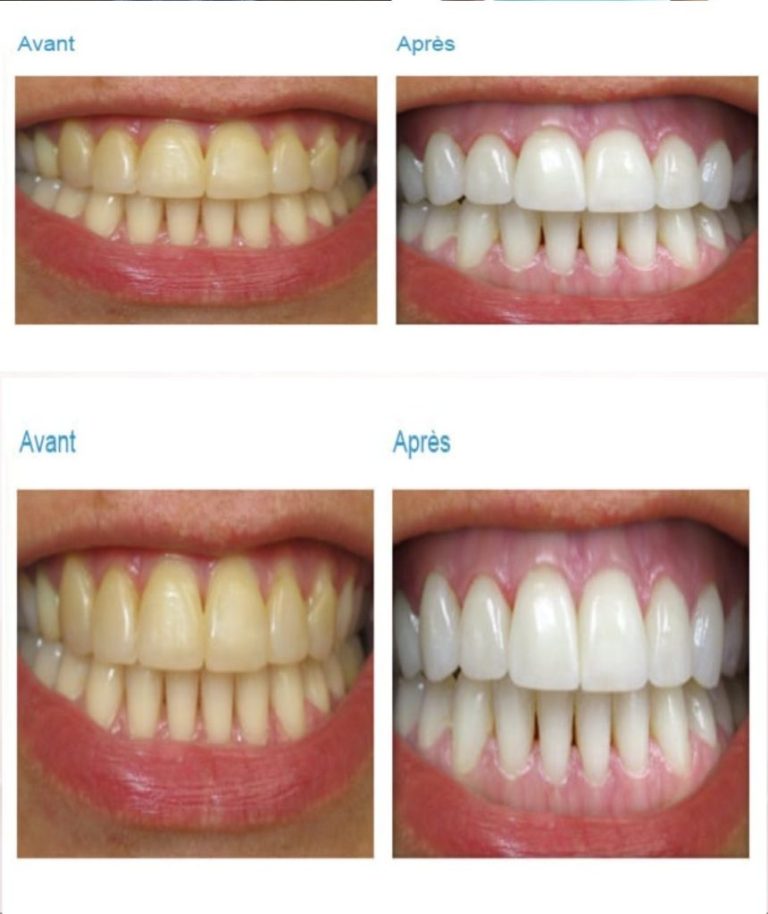 Jak naturalnie wybielić zęby za pomocą olejku z drzewa herbacianego