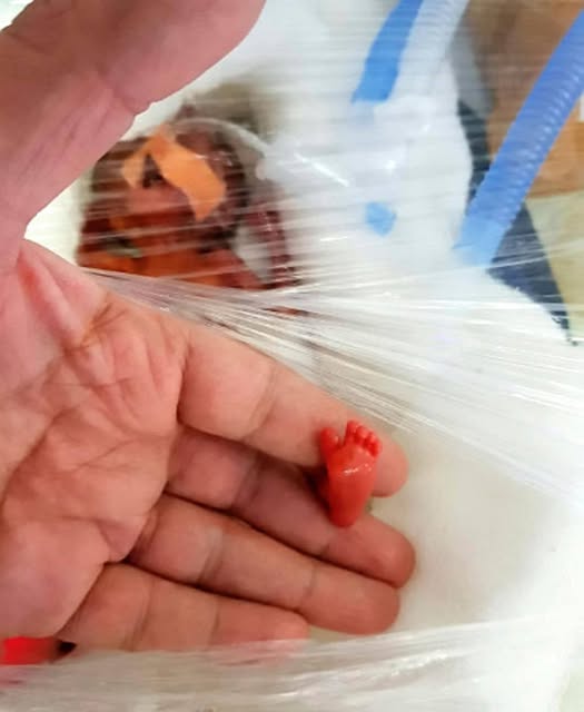 Niesamowita historia Tru Beare, która urodziła się ważąc zaledwie 500 gramów