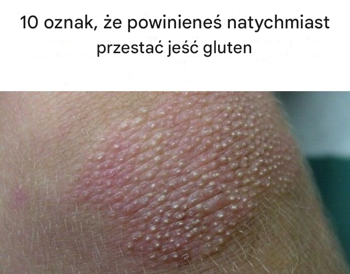 10 oznak, że powinieneś natychmiast przestać jeść gluten