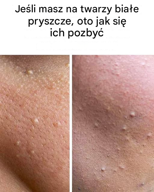 Jeśli masz białe pryszcze na twarzy, oto co one oznaczają i jak się ich pozbyć