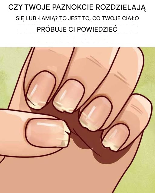 Łamliwe lub rozdwajające się paznokcie? Co Twoje ciało może Ci próbować powiedzieć