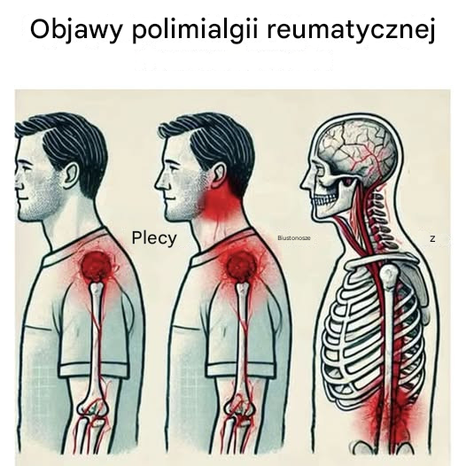 Objawy, na które należy zwrócić uwagę, mogące sugerować, że cierpisz na polimialgię reumatyczną