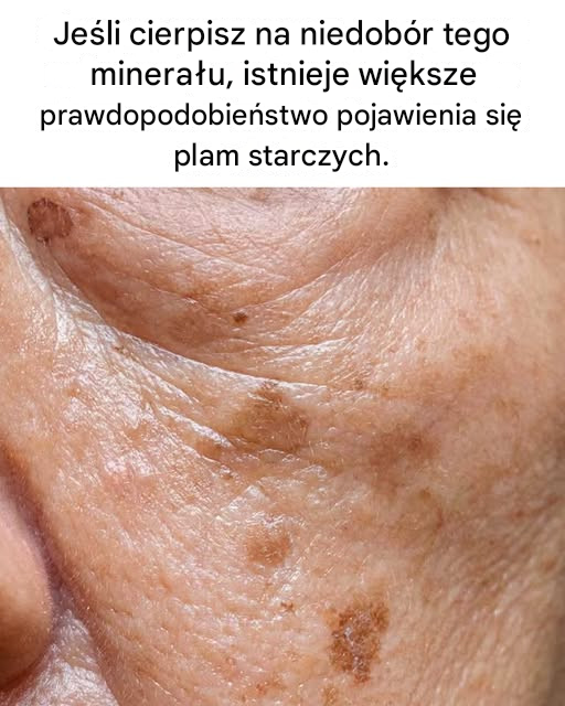 Jeśli cierpisz na niedobór tego minerału, istnieje większe prawdopodobieństwo pojawienia się plam starczych.